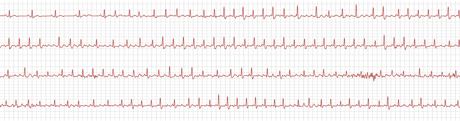 Real triaged alert strip — AF / flutter