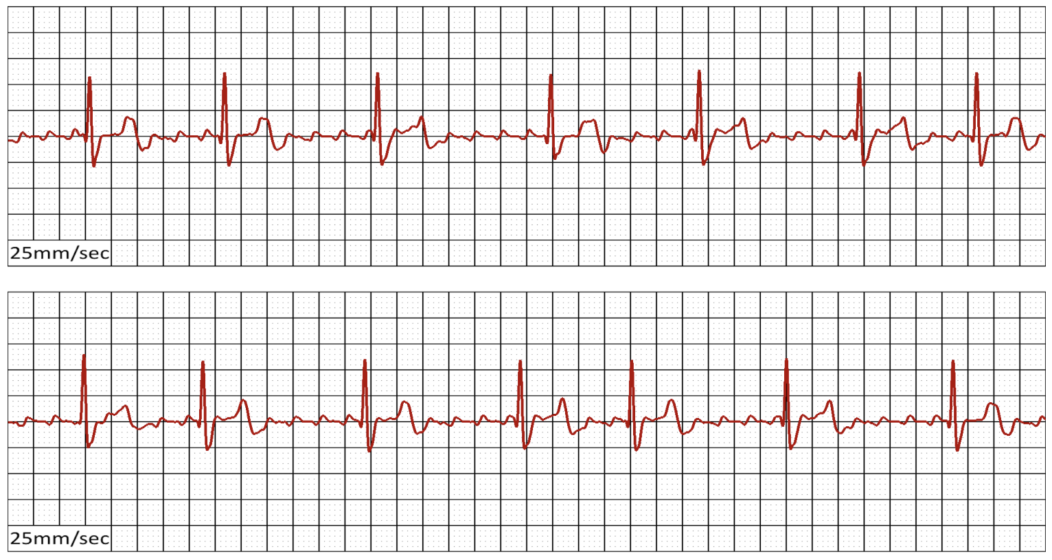 ECG strip — Atrial Flutter with variable ventricular conduction