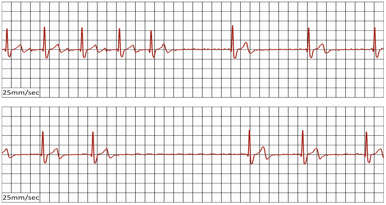 ECG strip — Atrial Fibrillation with Slow Ventricular Response