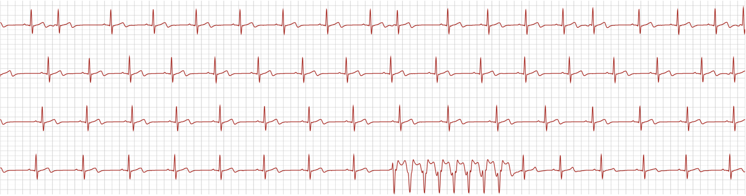 Real triaged alert strip — non-sustained VT