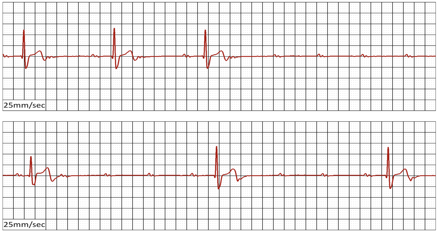 ECG strip — Complete Heart Block
