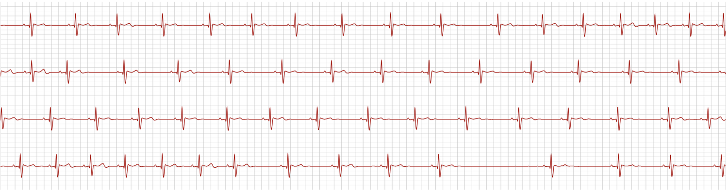 Real triaged alert strip — 3.1 sec pause