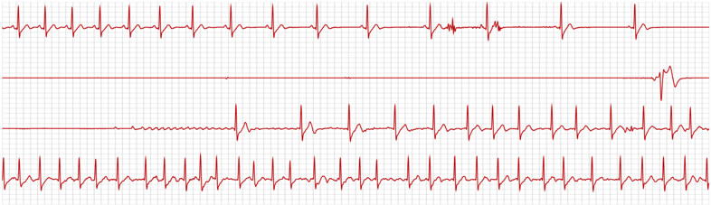 Real HeartBug strip — 20.7 second sinus arrest followed by AF